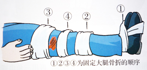 4.小腿骨折固定